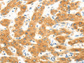 The image on the left is immunohistochemistry of paraffin-embedded Human liver cancer tissue using CSB-PA179581(MAP2K6 Antibody) at dilution 1/30, on the right is treated with fusion protein. (Original magnification: ×200)