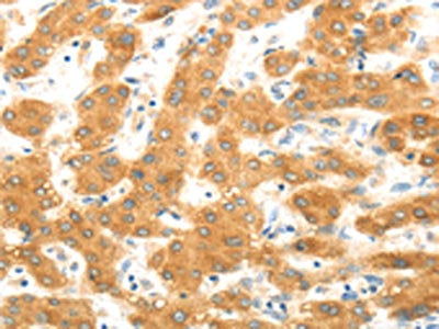 The image on the left is immunohistochemistry of paraffin-embedded Human liver cancer tissue using CSB-PA179581(MAP2K6 Antibody) at dilution 1/30, on the right is treated with fusion protein. (Original magnification: ×200)