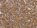 The image on the left is immunohistochemistry of paraffin-embedded Human prostate cancer tissue using CSB-PA179611(AATK Antibody) at dilution 1/45, on the right is treated with synthetic peptide. (Original magnification: ×200)