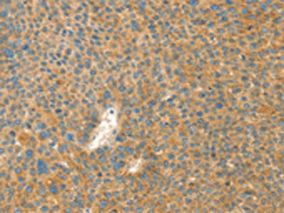 The image on the left is immunohistochemistry of paraffin-embedded Human liver cancer tissue using CSB-PA179815(AANAT Antibody) at dilution 1/40, on the right is treated with fusion protein. (Original magnification: ×200)
