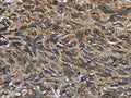 The image on the left is immunohistochemistry of paraffin-embedded Human esophagus cancer tissue using CSB-PA180065(GYPC Antibody) at dilution 1/60, on the right is treated with fusion protein. (Original magnification: ×200)