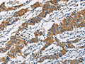 The image on the left is immunohistochemistry of paraffin-embedded Human gastic cancer tissue using CSB-PA180077(PIP4K2A Antibody) at dilution 1/40, on the right is treated with fusion protein. (Original magnification: ×200)