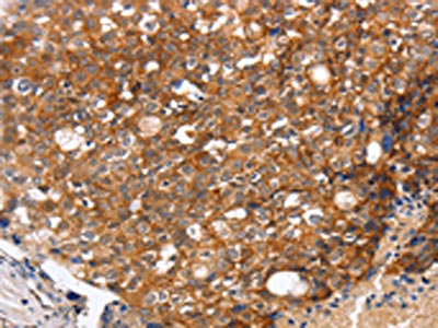 The image on the left is immunohistochemistry of paraffin-embedded Human breast cancer tissue using CSB-PA180170(OMG Antibody) at dilution 1/20, on the right is treated with fusion protein. (Original magnification: ×200)