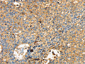 The image on the left is immunohistochemistry of paraffin-embedded Human lung cancer tissue using CSB-PA180349(MAPK6 Antibody) at dilution 1/40, on the right is treated with synthetic peptide. (Original magnification: ×200)