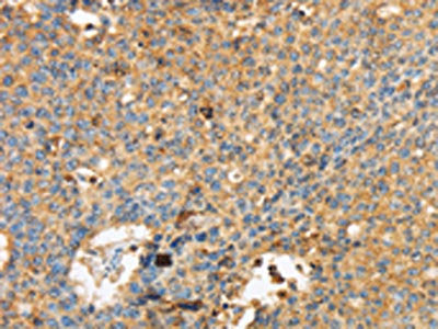 The image on the left is immunohistochemistry of paraffin-embedded Human lung cancer tissue using CSB-PA180349(MAPK6 Antibody) at dilution 1/40, on the right is treated with synthetic peptide. (Original magnification: ×200)