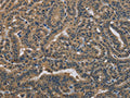 The image on the left is immunohistochemistry of paraffin-embedded Human thyroid cancer tissue using CSB-PA180704(DNAJA1 Antibody) at dilution 1/30, on the right is treated with fusion protein. (Original magnification: ×200)