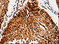 The image is immunohistochemistry of paraffin-embedded Human cervical cancer tissue using CSB-PA181054(ABCB5 Antibody) at dilution 1/10. (Original magnification: ×200)