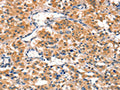 The image on the left is immunohistochemistry of paraffin-embedded Human thyroid cancer tissue using CSB-PA181130(AIMP1 Antibody) at dilution 1/40, on the right is treated with synthetic peptide. (Original magnification: ×200)