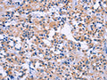 The image on the left is immunohistochemistry of paraffin-embedded Human thyroid cancer tissue using CSB-PA181246(DUSP22 Antibody) at dilution 1/60, on the right is treated with fusion protein. (Original magnification: ×200)