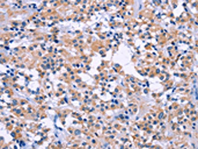 The image on the left is immunohistochemistry of paraffin-embedded Human thyroid cancer tissue using CSB-PA181246(DUSP22 Antibody) at dilution 1/60, on the right is treated with fusion protein. (Original magnification: ×200)