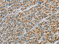 The image on the left is immunohistochemistry of paraffin-embedded Human liver cancer tissue using CSB-PA181544(EHHADH Antibody) at dilution 1/20, on the right is treated with fusion protein. (Original magnification: ×200)