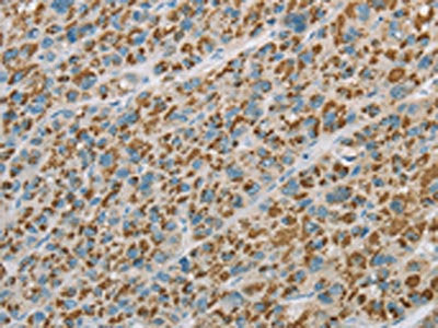 The image on the left is immunohistochemistry of paraffin-embedded Human liver cancer tissue using CSB-PA181544(EHHADH Antibody) at dilution 1/20, on the right is treated with fusion protein. (Original magnification: ×200)