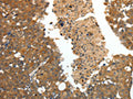 The image on the left is immunohistochemistry of paraffin-embedded Human breast cancer tissue using CSB-PA181901(CRP Antibody) at dilution 1/80, on the right is treated with fusion protein. (Original magnification: ×200)