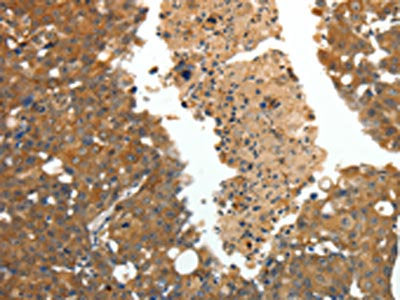 The image on the left is immunohistochemistry of paraffin-embedded Human breast cancer tissue using CSB-PA181901(CRP Antibody) at dilution 1/80, on the right is treated with fusion protein. (Original magnification: ×200)