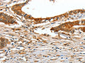 The image on the left is immunohistochemistry of paraffin-embedded Human colon cancer tissue using CSB-PA182143(COL1A2 Antibody) at dilution 1/70, on the right is treated with fusion protein. (Original magnification: ×200)