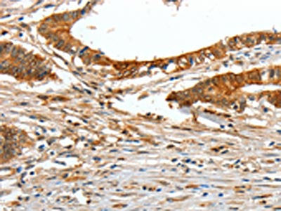 The image on the left is immunohistochemistry of paraffin-embedded Human colon cancer tissue using CSB-PA182143(COL1A2 Antibody) at dilution 1/70, on the right is treated with fusion protein. (Original magnification: ×200)