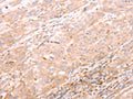 The image on the left is immunohistochemistry of paraffin-embedded Human esophagus cancer tissue using CSB-PA182593(ALPPL2 Antibody) at dilution 1/20, on the right is treated with synthetic peptide. (Original magnification: ×200)