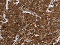 The image on the left is immunohistochemistry of paraffin-embedded Human liver cancer tissue using CSB-PA182654(FASTKD1 Antibody) at dilution 1/60, on the right is treated with fusion protein. (Original magnification: ×200)
