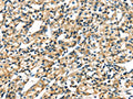 The image on the left is immunohistochemistry of paraffin-embedded Human prostate cancer tissue using CSB-PA182687(KRT17 Antibody) at dilution 1/40, on the right is treated with fusion protein. (Original magnification: ×200)