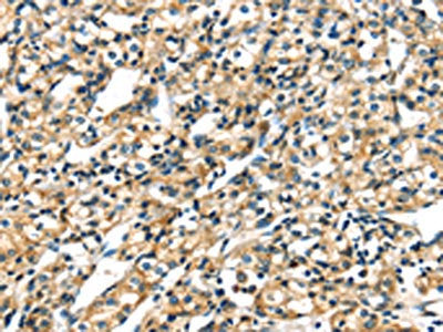 The image on the left is immunohistochemistry of paraffin-embedded Human prostate cancer tissue using CSB-PA182687(KRT17 Antibody) at dilution 1/40, on the right is treated with fusion protein. (Original magnification: ×200)