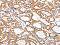 The image on the left is immunohistochemistry of paraffin-embedded Human thyroid cancer tissue using CSB-PA182772(ACSBG1 Antibody) at dilution 1/25, on the right is treated with fusion protein. (Original magnification: ×200)