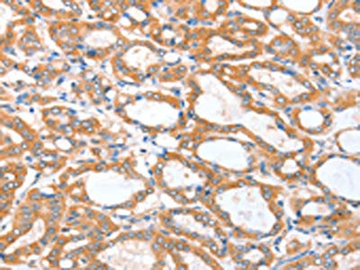 The image on the left is immunohistochemistry of paraffin-embedded Human thyroid cancer tissue using CSB-PA182772(ACSBG1 Antibody) at dilution 1/25, on the right is treated with fusion protein. (Original magnification: ×200)