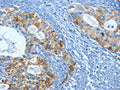 The image on the left is immunohistochemistry of paraffin-embedded Human cervical cancer tissue using CSB-PA182867(FSCN1 Antibody) at dilution 1/20, on the right is treated with fusion protein. (Original magnification: ×200)