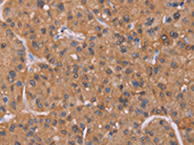 The image on the left is immunohistochemistry of paraffin-embedded Human liver cancer tissue using CSB-PA182905(CALCA Antibody) at dilution 1/25, on the right is treated with synthetic peptide. (Original magnification: ×200)