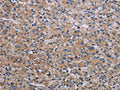 The image on the left is immunohistochemistry of paraffin-embedded Human prostate cancer tissue using CSB-PA182949(RPS6KB2 Antibody) at dilution 1/40, on the right is treated with synthetic peptide. (Original magnification: ×200)