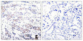 Immunohistochemical analysis of paraffin-embedded human breast carcinoma tissue using Elk-1(Ab-383) Antibody(left) or the same antibody preincubated with blocking peptide(right).