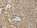 The image on the left is immunohistochemistry of paraffin-embedded Human lung cancer tissue using CSB-PA183145(DNAJB1 Antibody) at dilution 1/40, on the right is treated with fusion protein. (Original magnification: ×200)