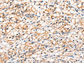 The image on the left is immunohistochemistry of paraffin-embedded Human renal cancer tissue using CSB-PA183226(GLP1R Antibody) at dilution 1/20, on the right is treated with fusion protein. (Original magnification: ×200)