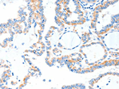 The image on the left is immunohistochemistry of paraffin-embedded Human thyroid cancer tissue using CSB-PA183593(TLR2 Antibody) at dilution 1/55, on the right is treated with fusion protein. (Original magnification: ×200)