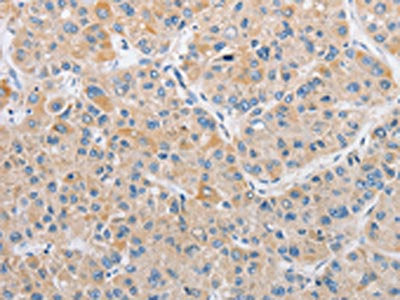 The image on the left is immunohistochemistry of paraffin-embedded Human liver cancer tissue using CSB-PA183796(ARHGEF9 Antibody) at dilution 1/50, on the right is treated with fusion protein. (Original magnification: ×200)