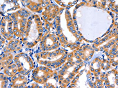 The image on the left is immunohistochemistry of paraffin-embedded Human thyroid cancer tissue using CSB-PA183839(GFER Antibody) at dilution 1/50, on the right is treated with fusion protein. (Original magnification: ×200)