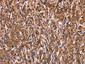 The image on the left is immunohistochemistry of paraffin-embedded Human gastic cancer tissue using CSB-PA184311(LILRB1 Antibody) at dilution 1/50, on the right is treated with fusion protein. (Original magnification: ×200)