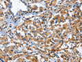 The image on the left is immunohistochemistry of paraffin-embedded Human thyroid cancer tissue using CSB-PA184322(CD244 Antibody) at dilution 1/50, on the right is treated with fusion protein. (Original magnification: ×200)