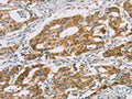 The image on the left is immunohistochemistry of paraffin-embedded Human gastic cancer tissue using CSB-PA184759(DMRT3 Antibody) at dilution 1/25, on the right is treated with fusion protein. (Original magnification: ×200)