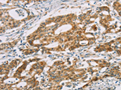 The image on the left is immunohistochemistry of paraffin-embedded Human gastic cancer tissue using CSB-PA184759(DMRT3 Antibody) at dilution 1/25, on the right is treated with fusion protein. (Original magnification: ×200)