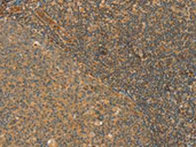 The image on the left is immunohistochemistry of paraffin-embedded Human tonsil tissue using CSB-PA185506(CPA2 Antibody) at dilution 1/40, on the right is treated with fusion protein. (Original magnification: ×200)