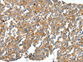 The image on the left is immunohistochemistry of paraffin-embedded Human breast cancer tissue using CSB-PA185715(CXCL12 Antibody) at dilution 1/40, on the right is treated with synthetic peptide. (Original magnification: ×200)