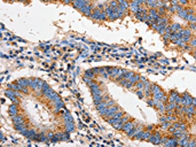 The image on the left is immunohistochemistry of paraffin-embedded Human colon cancer tissue using CSB-PA185779(FAS Antibody) at dilution 1/60, on the right is treated with fusion protein. (Original magnification: ×200)