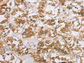 The image on the left is immunohistochemistry of paraffin-embedded Human thyroid cancer tissue using CSB-PA186108(CYP2E1 Antibody) at dilution 1/35, on the right is treated with fusion protein. (Original magnification: ×200)