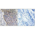 Immunohistochemistry analysis of paraffin-embedded human lung carcinoma tissue using MGST3 antibody.