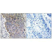 Immunohistochemistry analysis of paraffin-embedded human lung carcinoma tissue using MGST3 antibody.