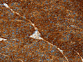 The image on the left is immunohistochemistry of paraffin-embedded Human liver cancer tissue using CSB-PA186229(ASGR1 Antibody) at dilution 1/50, on the right is treated with fusion protein. (Original magnification: ×200)