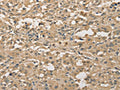 The image on the left is immunohistochemistry of paraffin-embedded Human thyroid cancer tissue using CSB-PA186785(ALDH8A1 Antibody) at dilution 1/30, on the right is treated with fusion protein. (Original magnification: ×200)