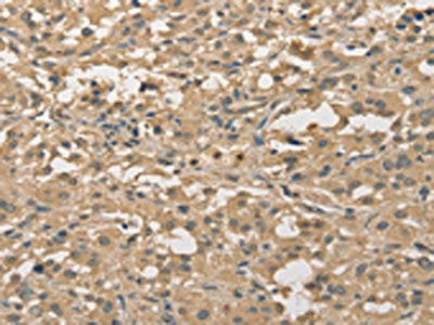 The image on the left is immunohistochemistry of paraffin-embedded Human thyroid cancer tissue using CSB-PA186785(ALDH8A1 Antibody) at dilution 1/30, on the right is treated with fusion protein. (Original magnification: ×200)
