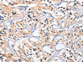 The image on the left is immunohistochemistry of paraffin-embedded Human thyroid cancer tissue using CSB-PA186887(CEP97 Antibody) at dilution 1/25, on the right is treated with fusion protein. (Original magnification: ×200)