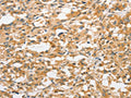 The image on the left is immunohistochemistry of paraffin-embedded Human thyroid cancer tissue using CSB-PA187039(ANAPC5 Antibody) at dilution 1/30, on the right is treated with fusion protein. (Original magnification: ×200)